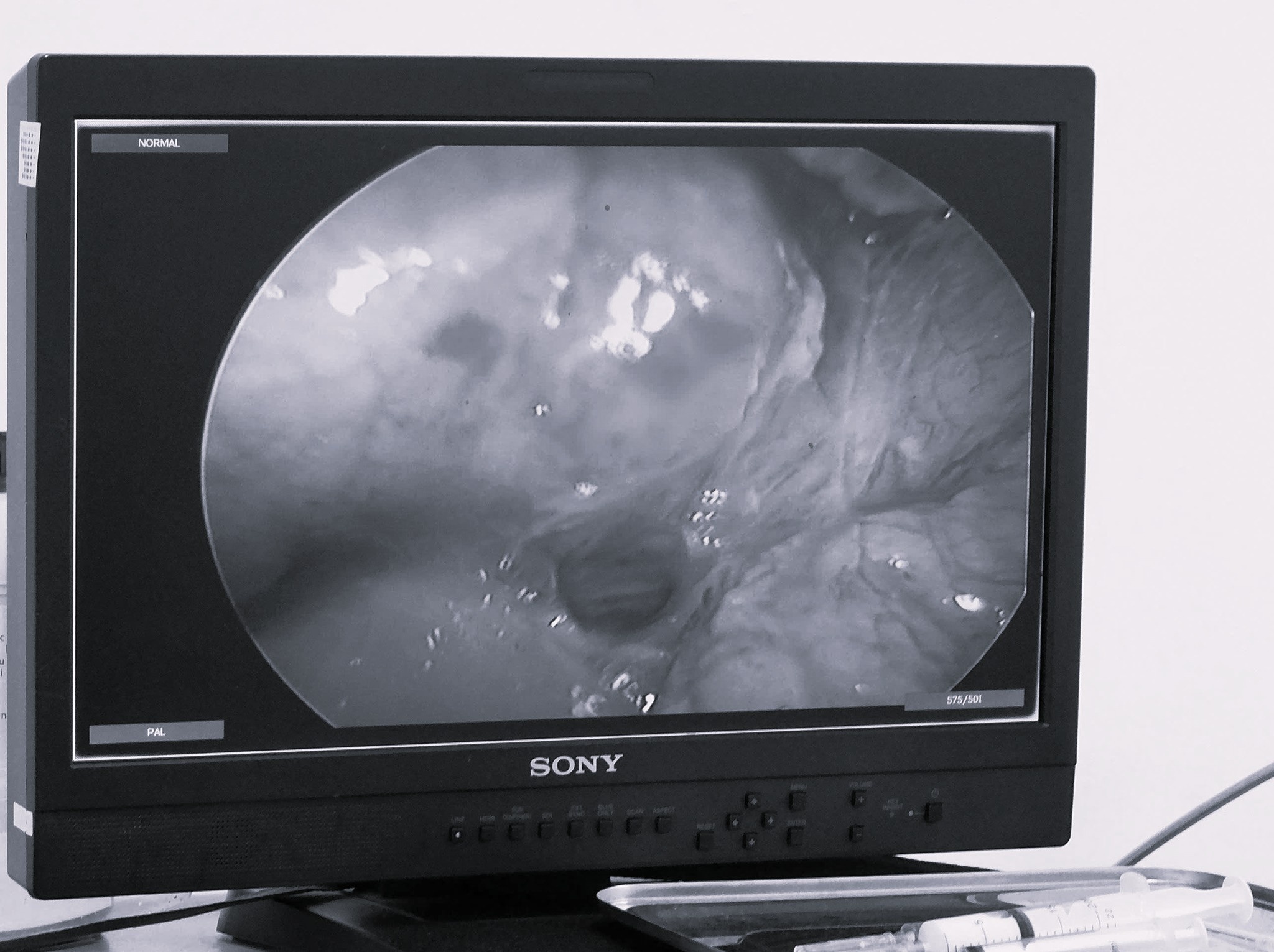 Thung da day vi thoi quen nhieu nguoi mac phai khi dau hinh anh