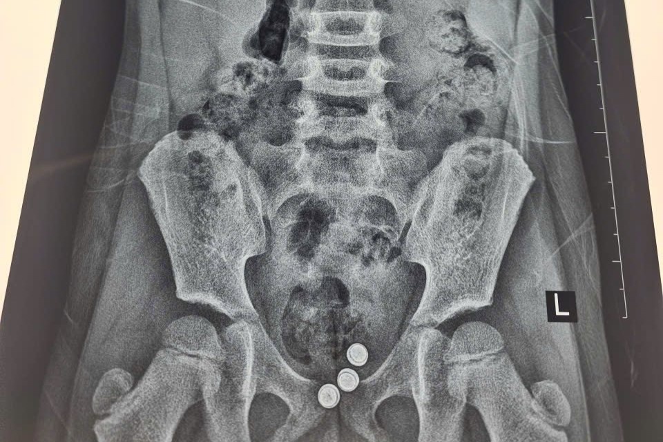 Be gai chay dich am dao keo dai vi nguyen nhan kho ngo hinh anh