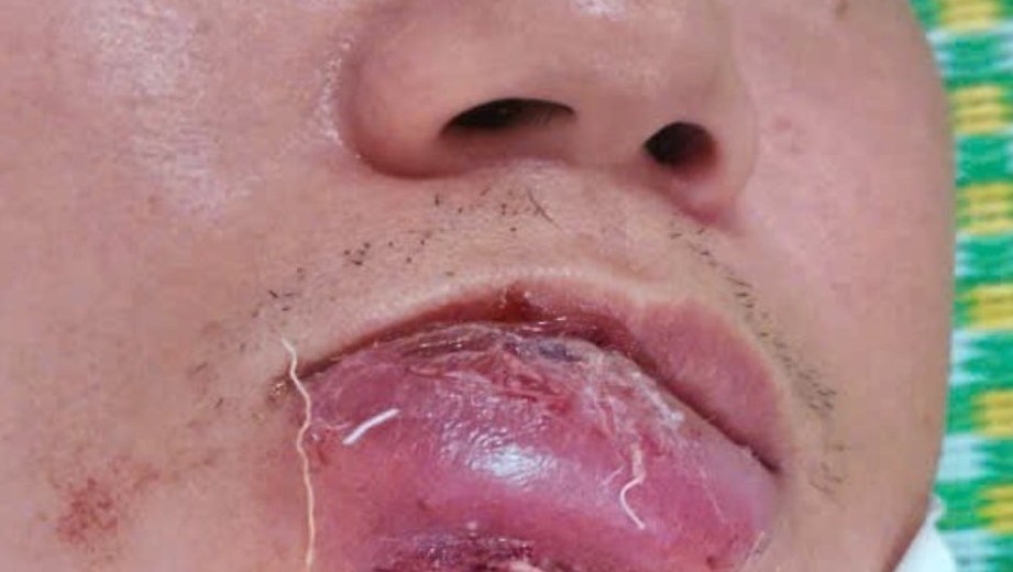 Ganh hau qua chi vi chu quan voi not mun o mep moi hinh anh