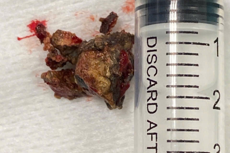 Bac si gap di vat kho tin, chiem toan bo hoc mui chang trai 34 tuoi hinh anh