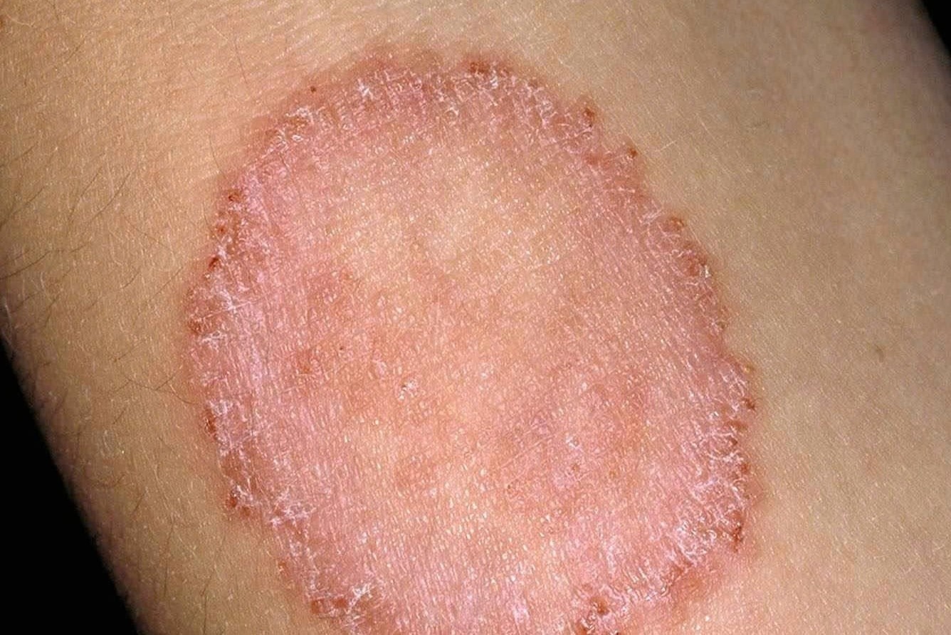 Dau hieu noi bat cua benh lac dong tien va cach xu tri hinh anh