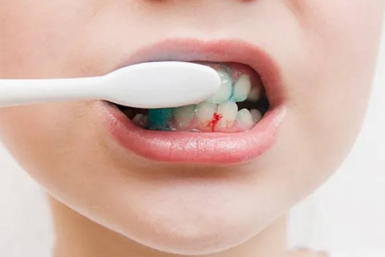 Vi sao bi chay mau chan rang? hinh anh