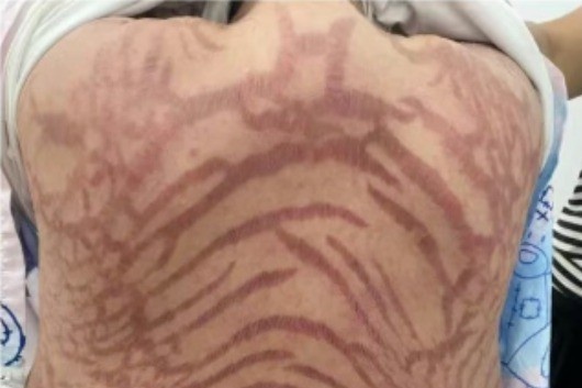 Nguoi phu nu co lan da ran sau 10 nam boi thuoc 'thuan Dong y' hinh anh