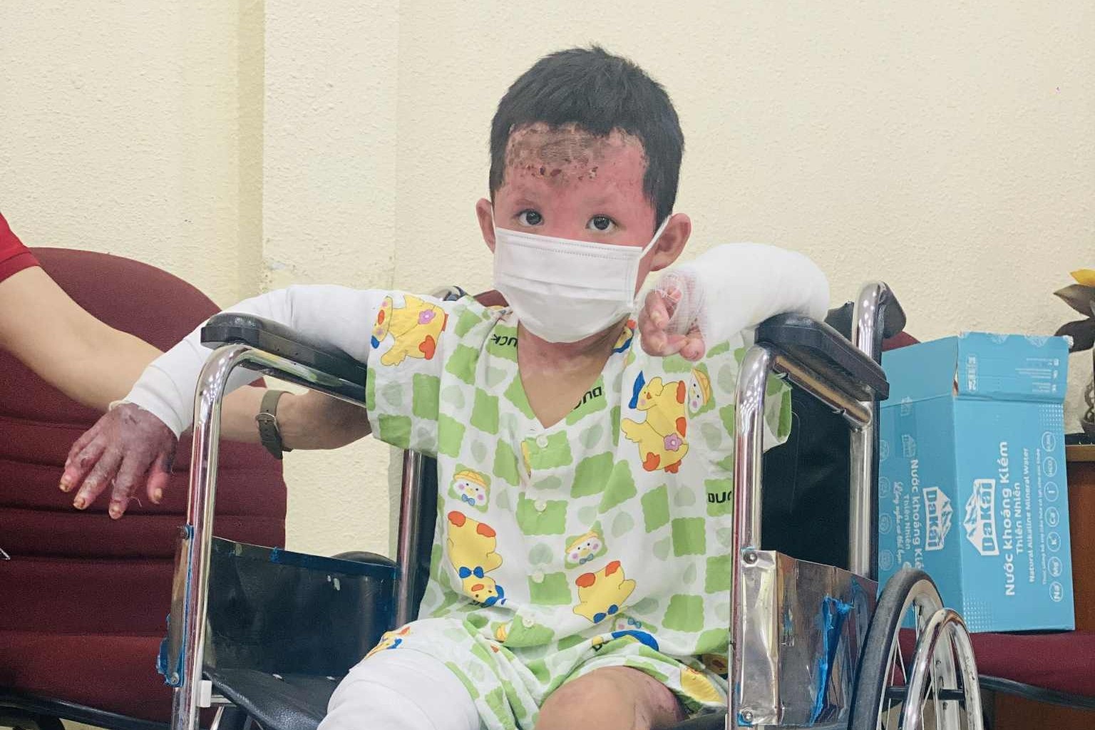 Tinh hinh be trai bi bong 65% co the trong vu phong hoa o Gia Lai hinh anh