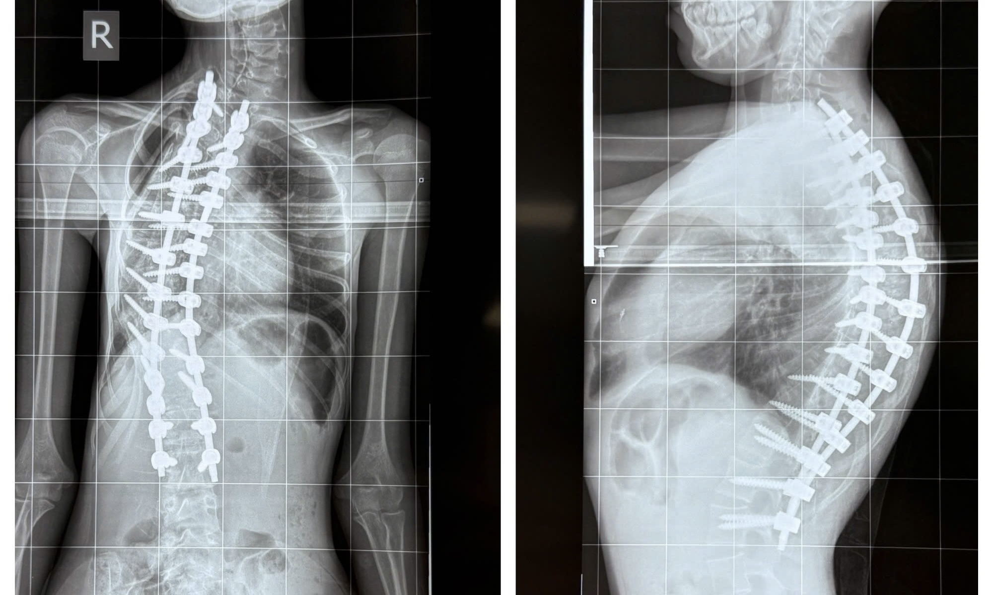 Be gai mac benh hiem, bac si BV Nhi dong 1 lan dau gap hinh anh