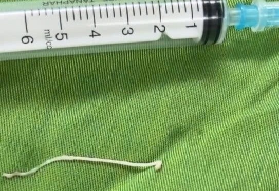 Phat hien o san ky sinh o mot noi khong ngo trong co the hinh anh