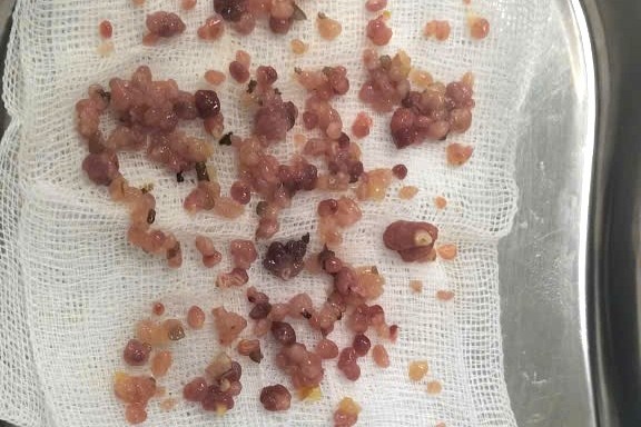 Bac si soc phat hien hang tram polyp dai trang khi noi soi hinh anh