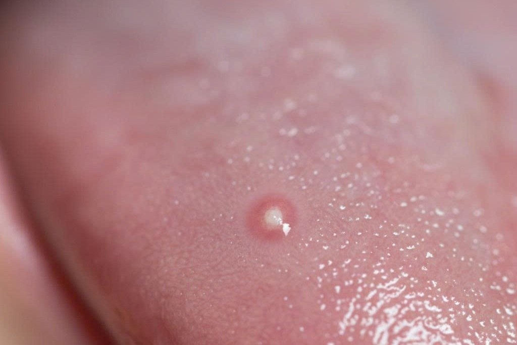 Dau hieu benh nguy hiem bieu hien ngay o luoi hinh anh