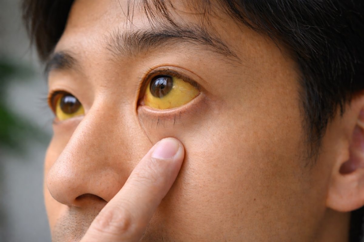 Can benh ve gan co the gay ung thu, kho phat hien o giai doan dau hinh anh