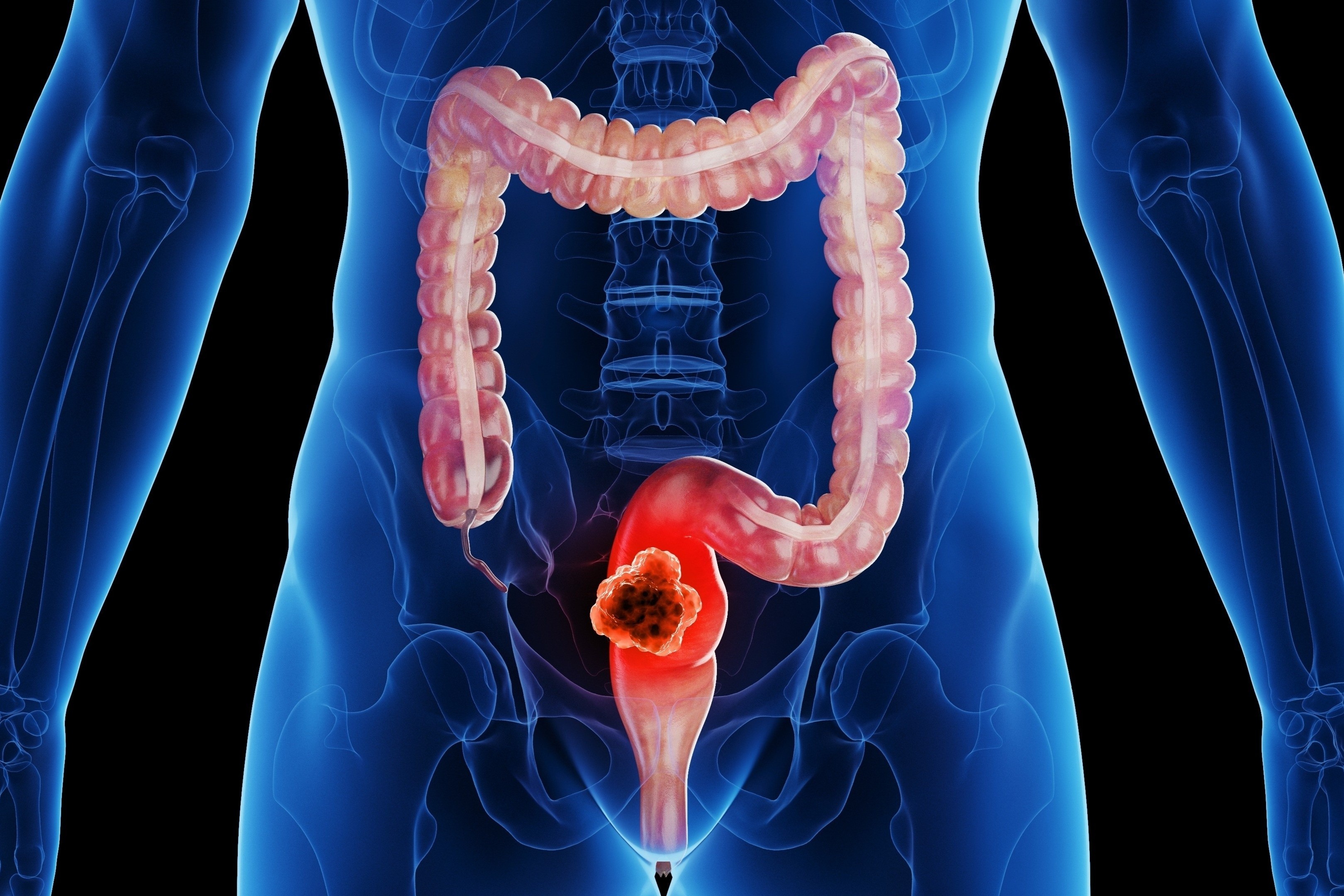 Mot loai ung thu dang tang nhanh bao dong o nguoi tre hinh anh