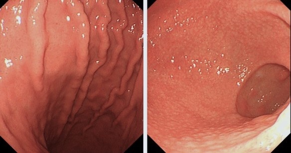 Thoi quen an uong khien ca gia dinh cung nhiem HP da day hinh anh