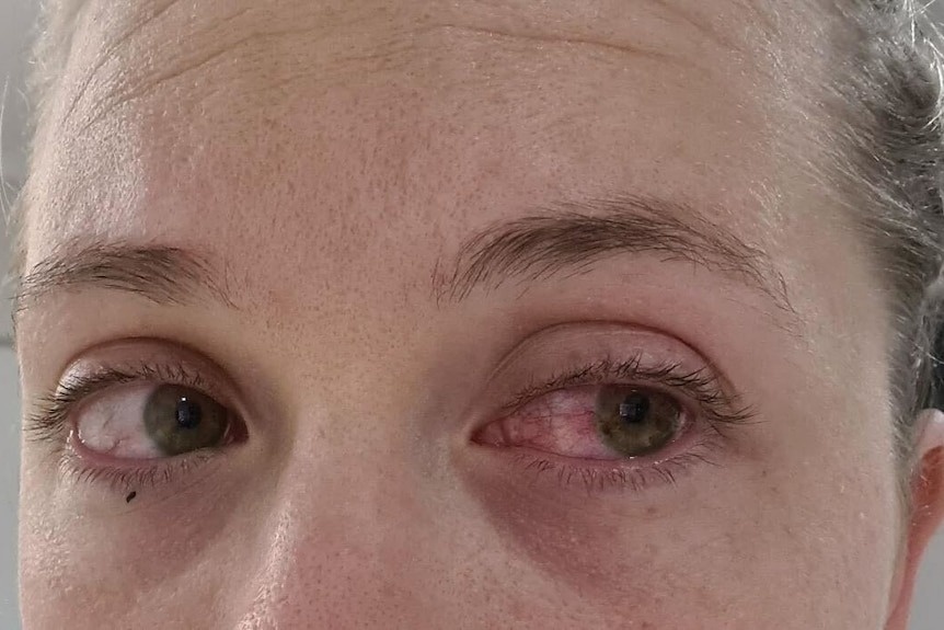 Bac si canh bao tac dung phu dang so, it nguoi biet den cua xam hinh hinh anh