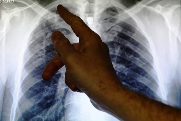 Benh lao quay tro lai, Malaysia phat canh bao khan hinh anh