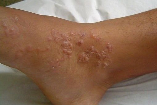 Thoi quen xau khien thanh nien nhiem cung luc 3 loai ky sinh trung hinh anh