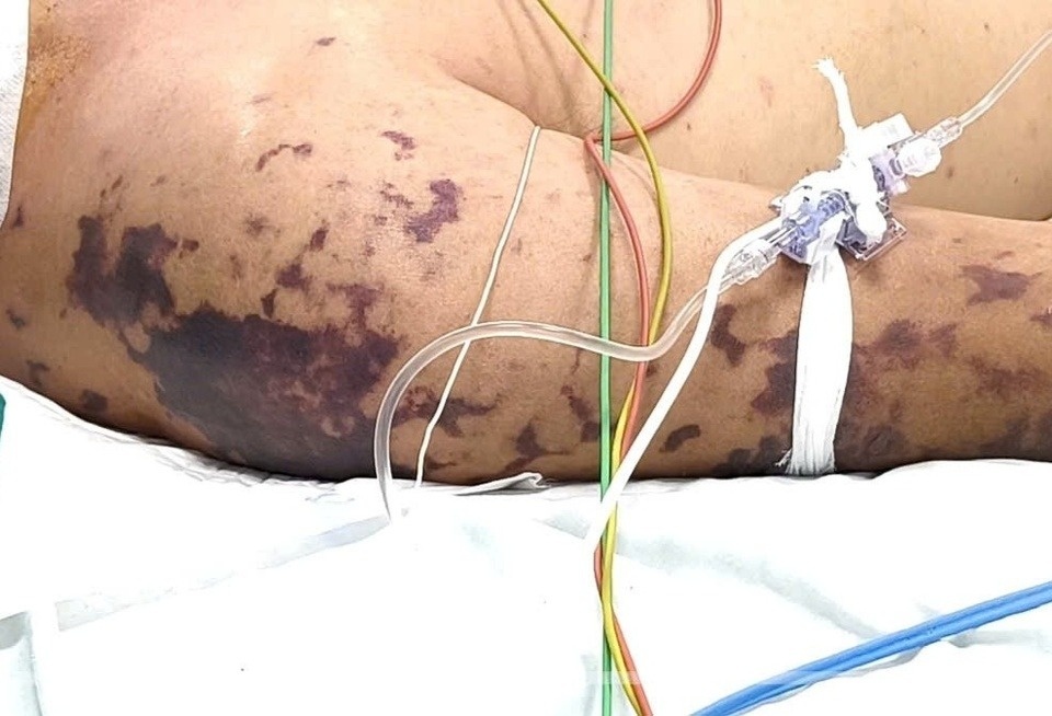 Tu con sot nhu cam cum, nguoi phu nu soc nhiem trung, suy da tang hinh anh