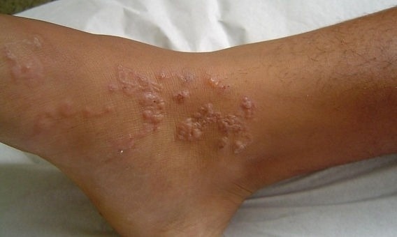 Giun chi chit, go ghe duoi da suot 2 nam nhung khong hay biet hinh anh