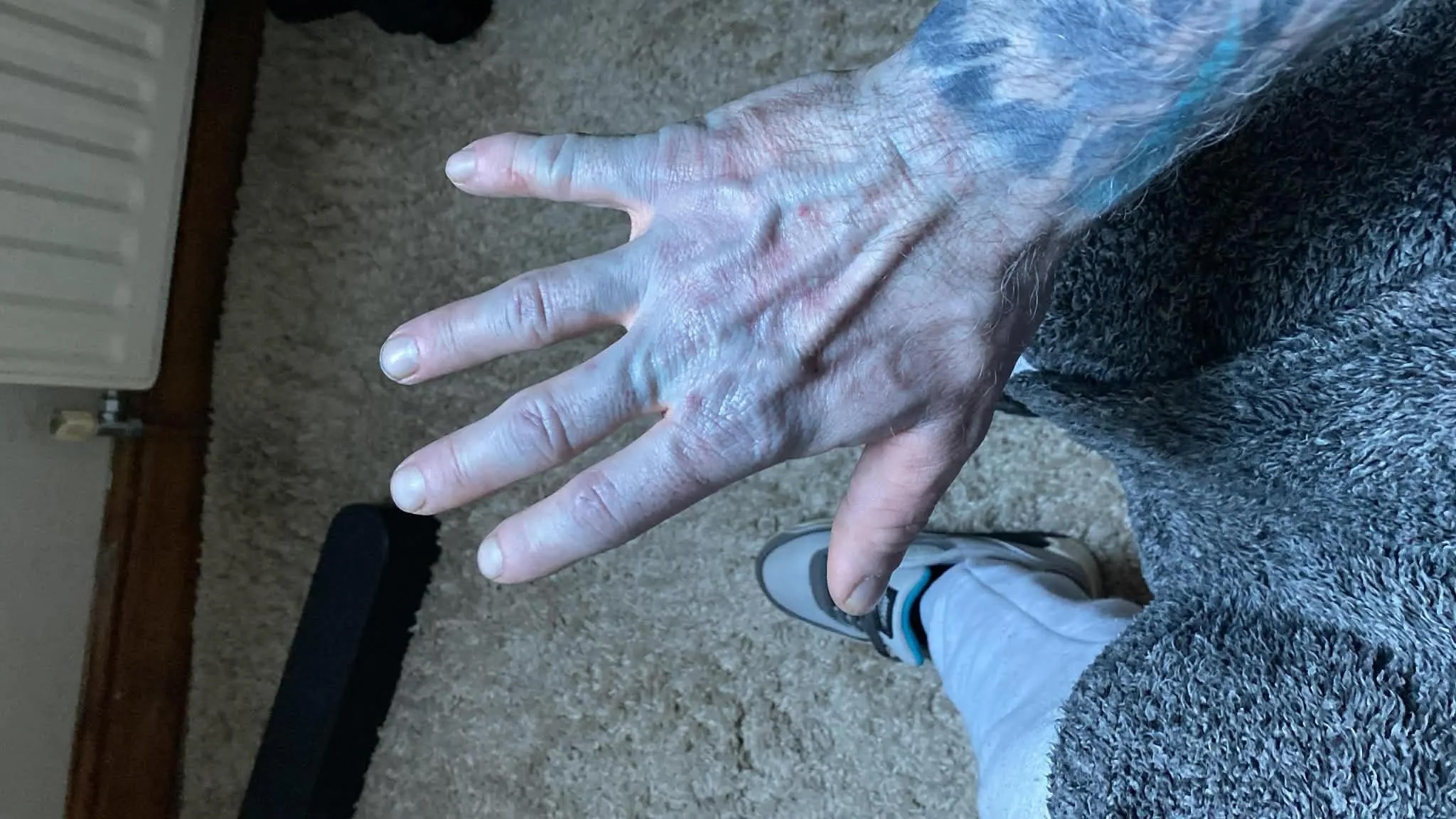 Hot hoang nhap vien vi da xanh nhu nhan vat Avatar hinh anh