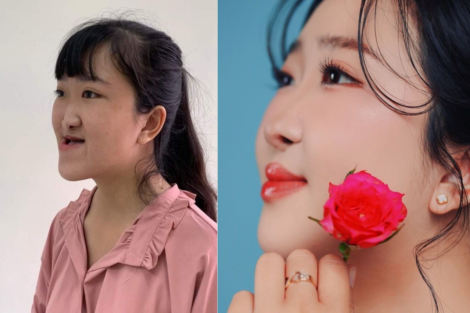 Co gai 25 tuoi 'lot xac' sau 4 lan phau thuat ham mat hinh anh