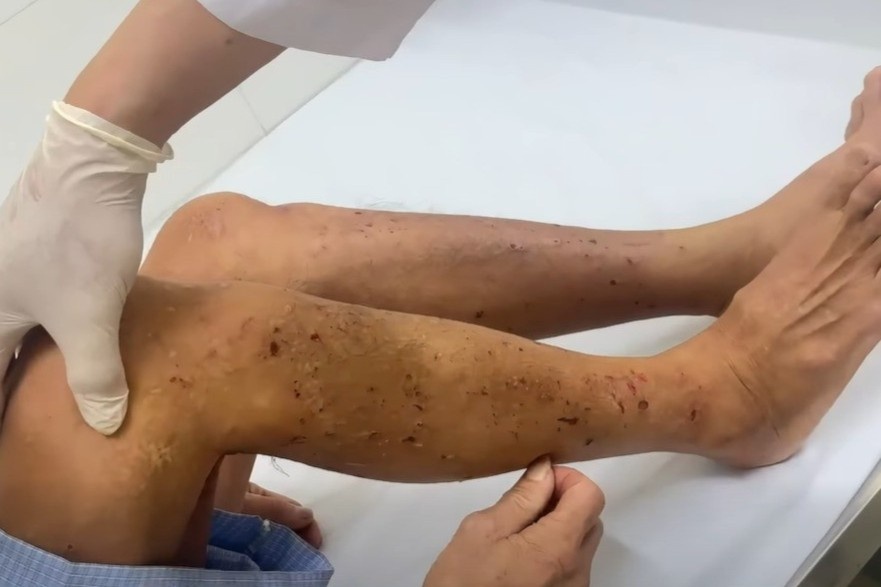 Nguoi dan ong nhiem cung luc san day cho va giun dua hinh anh