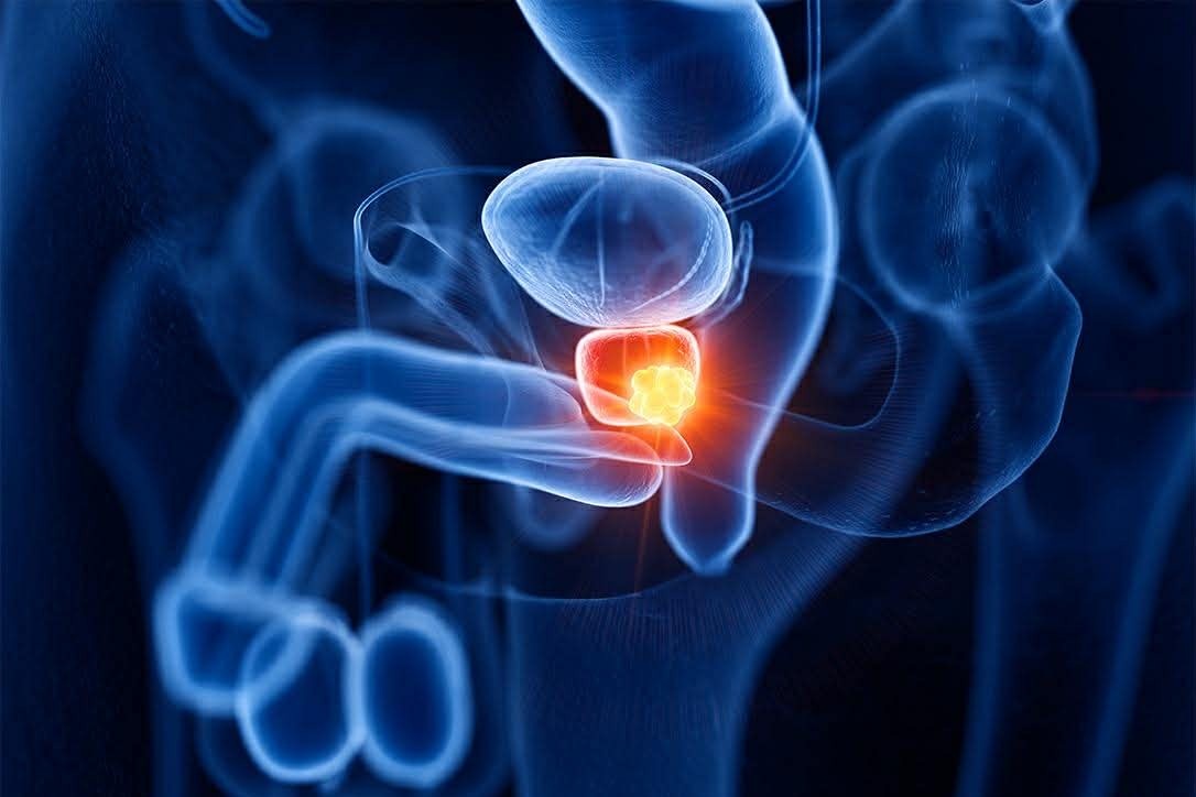 Mot gia dinh 4 nguoi cung mac mot loai ung thu hinh anh