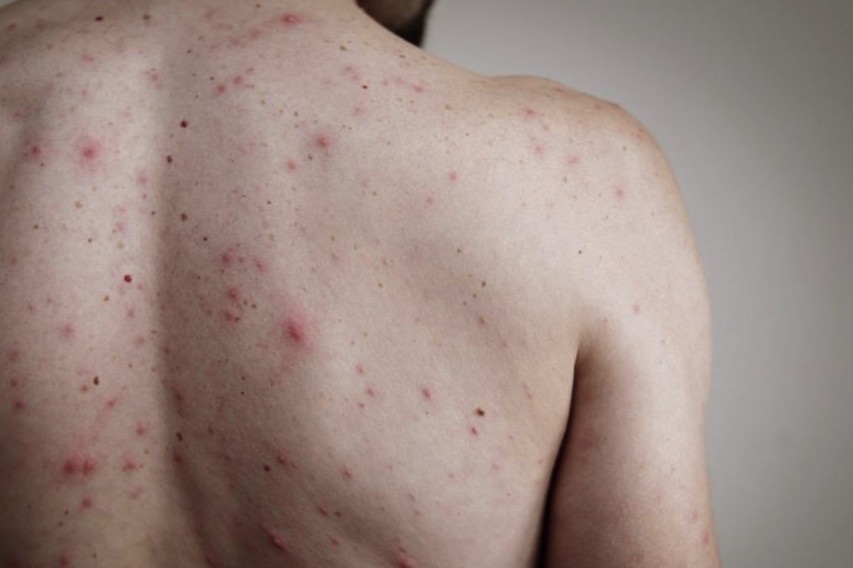 Noi ban la toan than, nam thanh nien mac benh tinh duc nguy hiem hinh anh