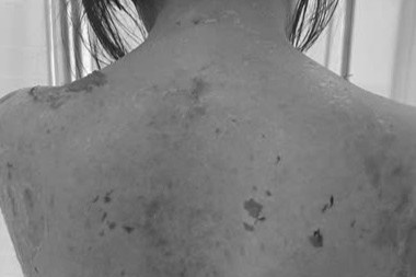 Bac si soc khi benh nhan den kham voi toan than bong troc hinh anh