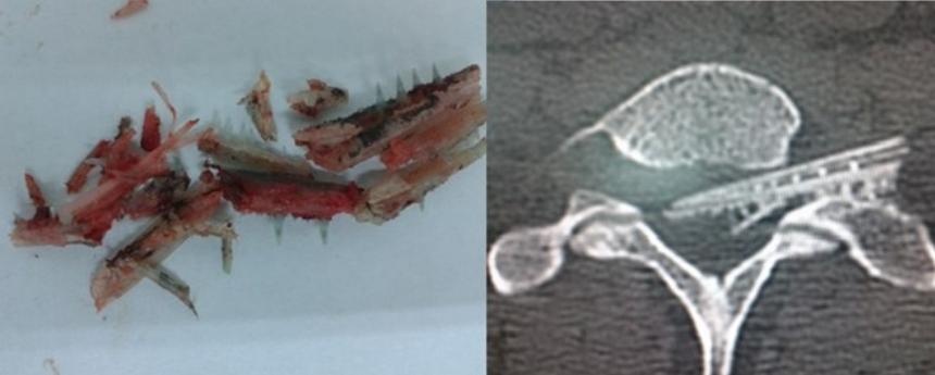 Các mẫu xương gắp ra khỏi cổ của du khách Nga.