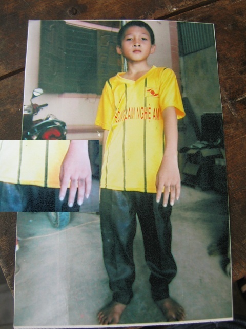 Những vết bầm trên tay cháu Hạnh mà gia đình tố do quá trình 