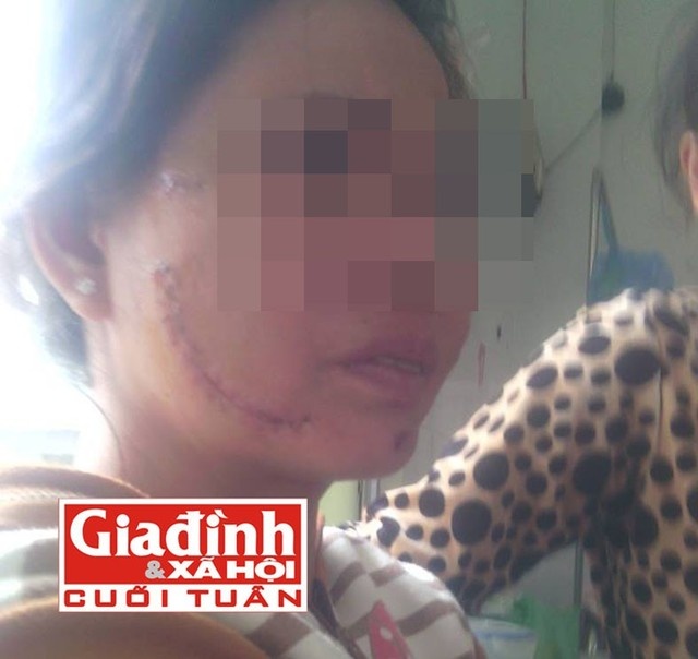 Chị Lùng đau đớn vì những vết thương do chồng rạch mặt.
