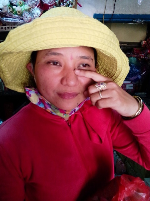 Chị Nga chỉ sống mũi bị gãy do nhóm côn đồ đánh đập cách đây 15 năm.