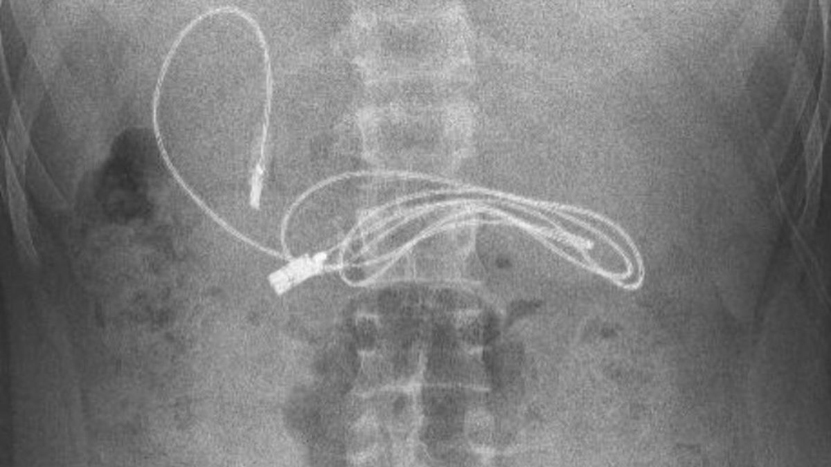 Thieu nien 15 tuoi nhap vien vi co day sac dai gan 1 met trong da day hinh anh