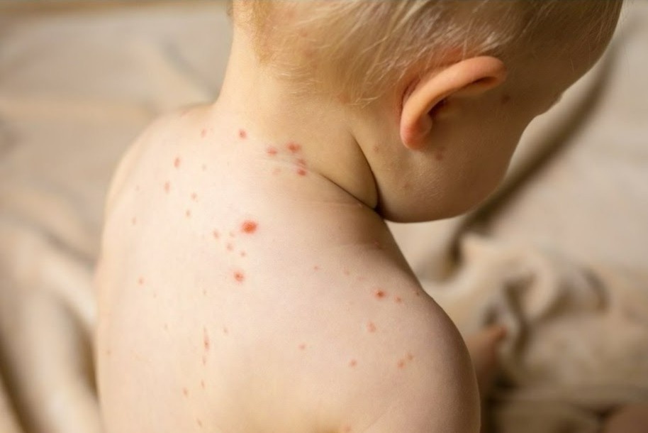 Phong benh soi anh 1