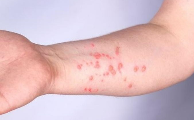 Dieu tri dau mua khi anh 1