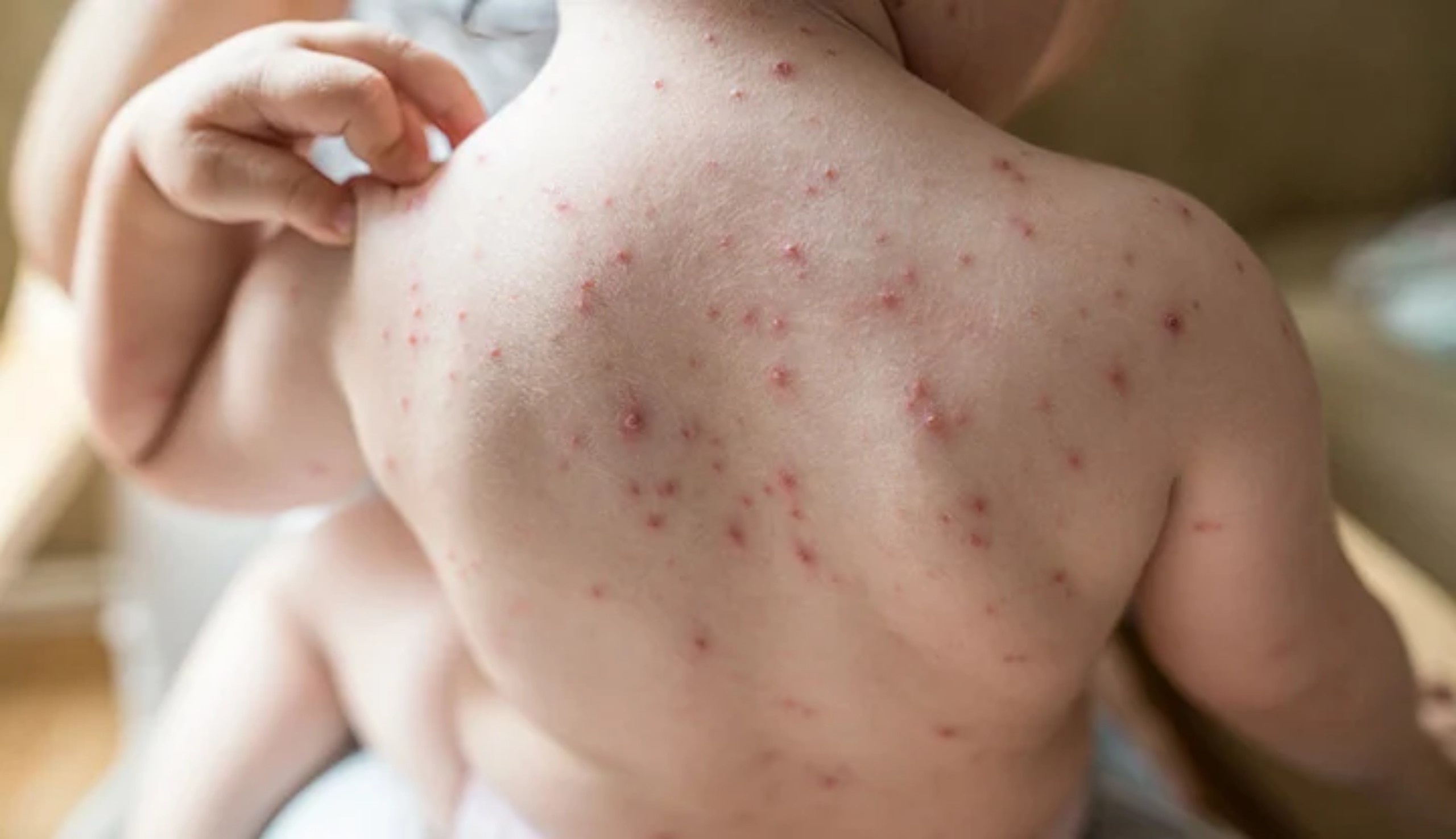 Điều trị thủy đậu  ảnh 1 Dieu tri thuy dau anh 1