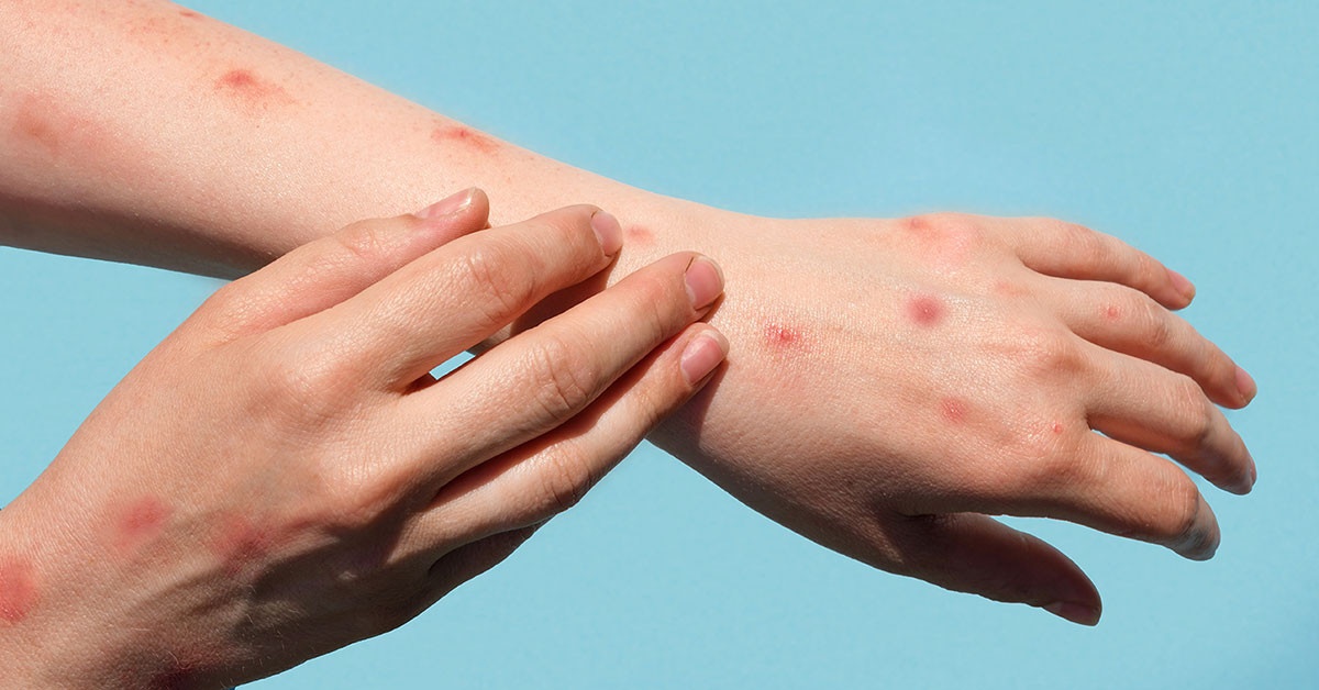 Benh dau mua khi tiep tuc gia tang o Nhat Ban hinh anh