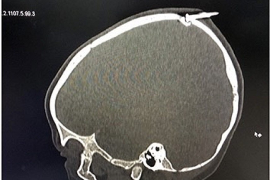 Be 2 tuoi o Dong Nai bi dinh dam xuyen xuong so hinh anh