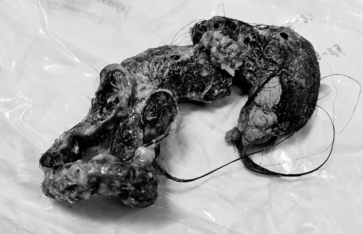 Bui toc gay tac ruot be gai 4 tuoi hinh anh