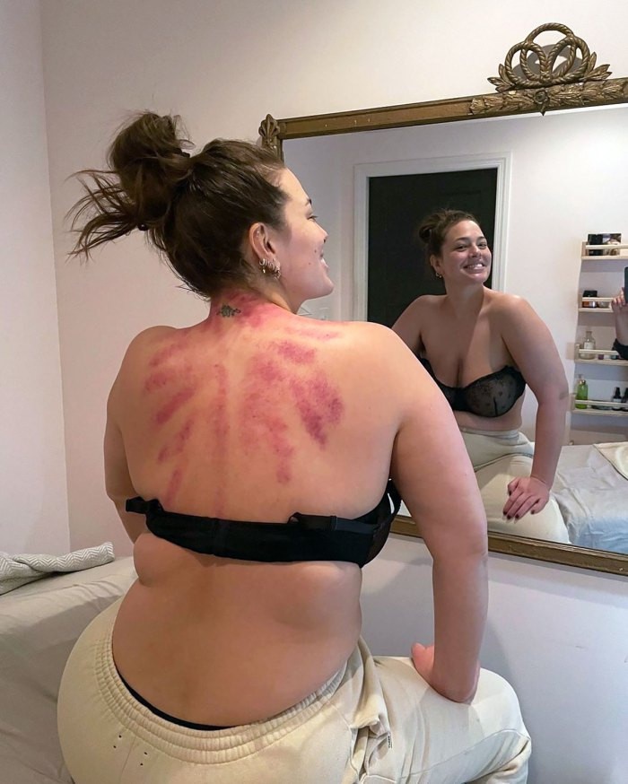 phương pháp trị liệu Gua sha ảnh 1 phuong phap tri lieu Gua sha anh 1