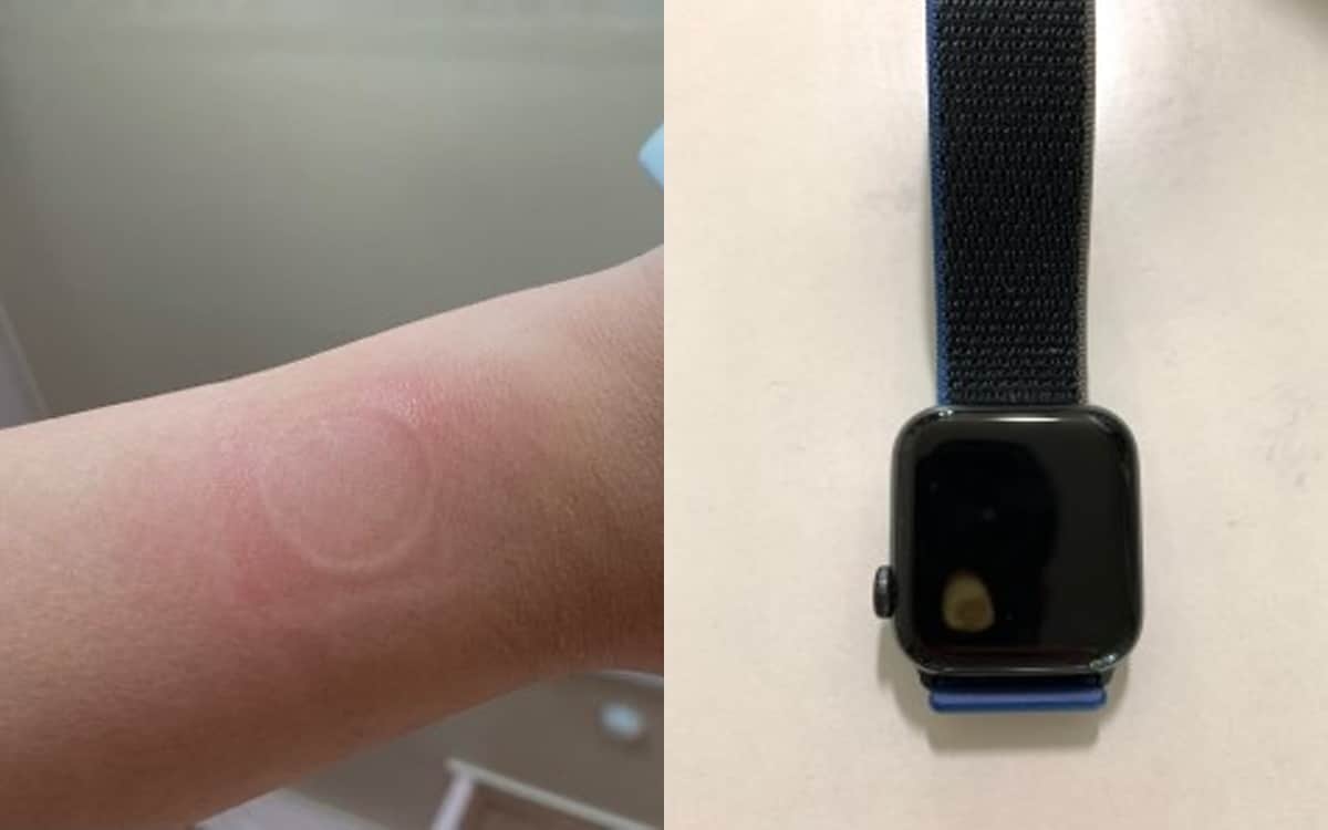 Apple Watch qua nhiet gay bong tay nguoi dung hinh anh