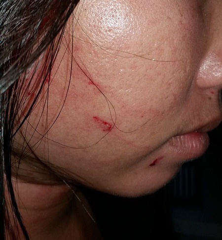 Vết thương trên người chị Nguyễn Thị Mỹ Hòa (ảnh do gia đình chị Hòa cung cấp)