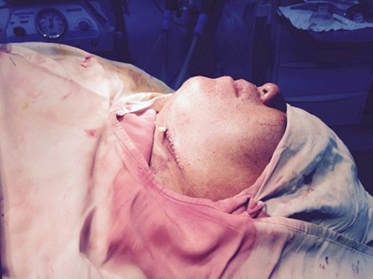 Cuu song nan nhan bi cay tre dam xuyen co hong hinh anh