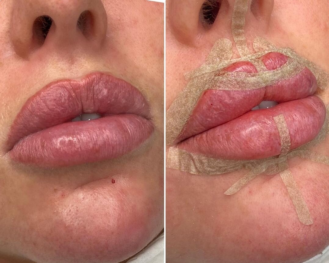 môi cánh bướm ảnh 6 moi canh buom anh 6