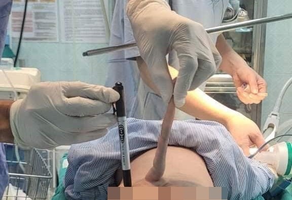 Cat 'duoi' di tat dai 14 cm cho be 4 thang tuoi hinh anh