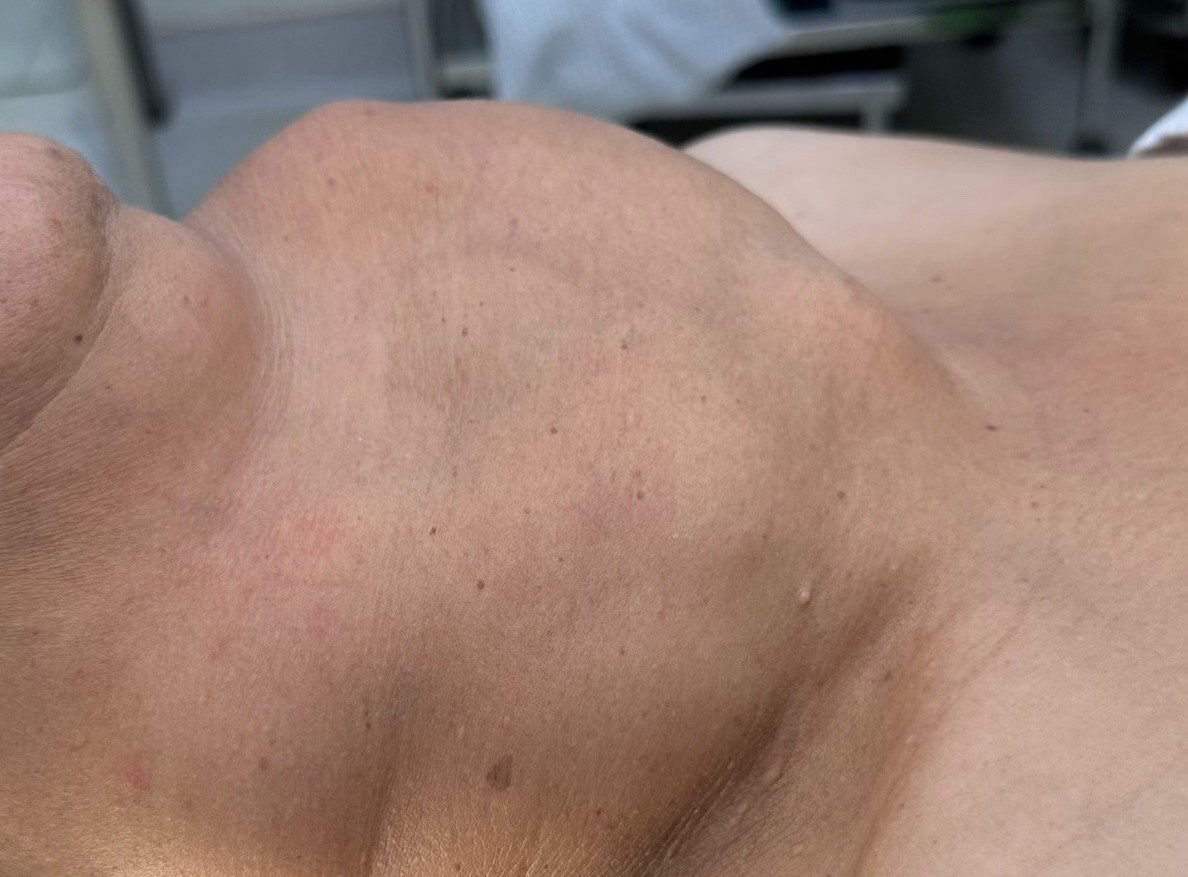 Nguoi phu nu mang khoi buou co khong lo suot 30 nam hinh anh