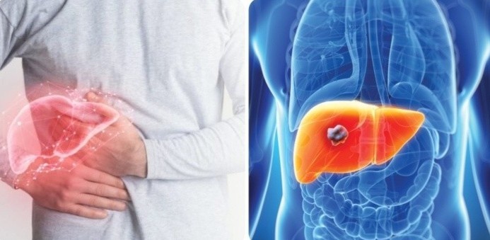 dau hieu ung thu gan anh 1