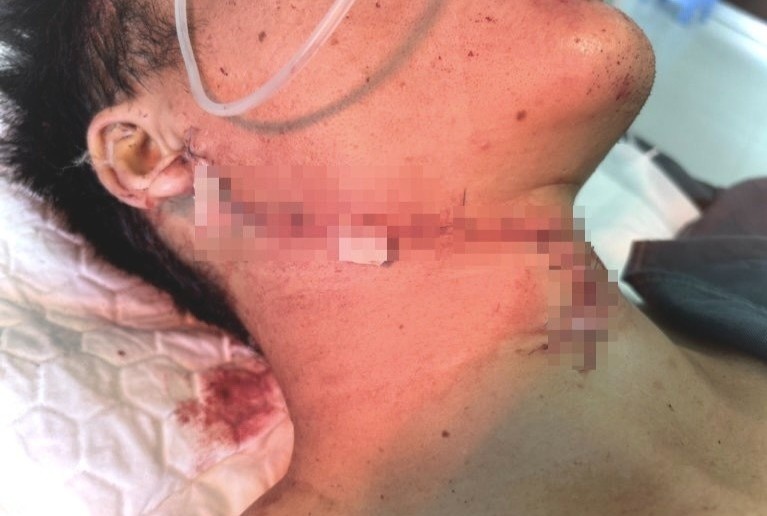 Thanh nien 23 tuoi bi rach co do nga vao tu kinh hinh anh