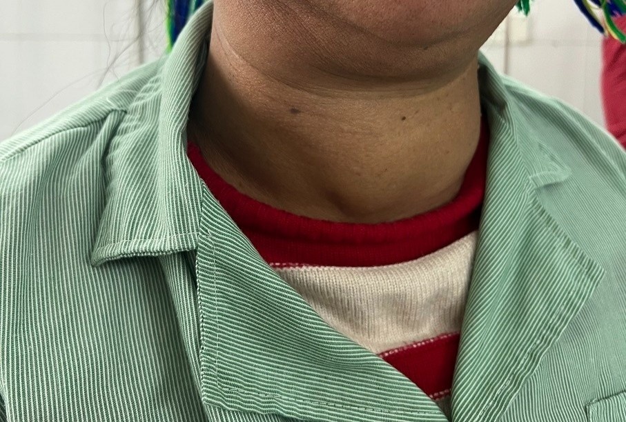 Nguoi phu nu mang khoi u khong lo chen duong tho suot 10 nam hinh anh