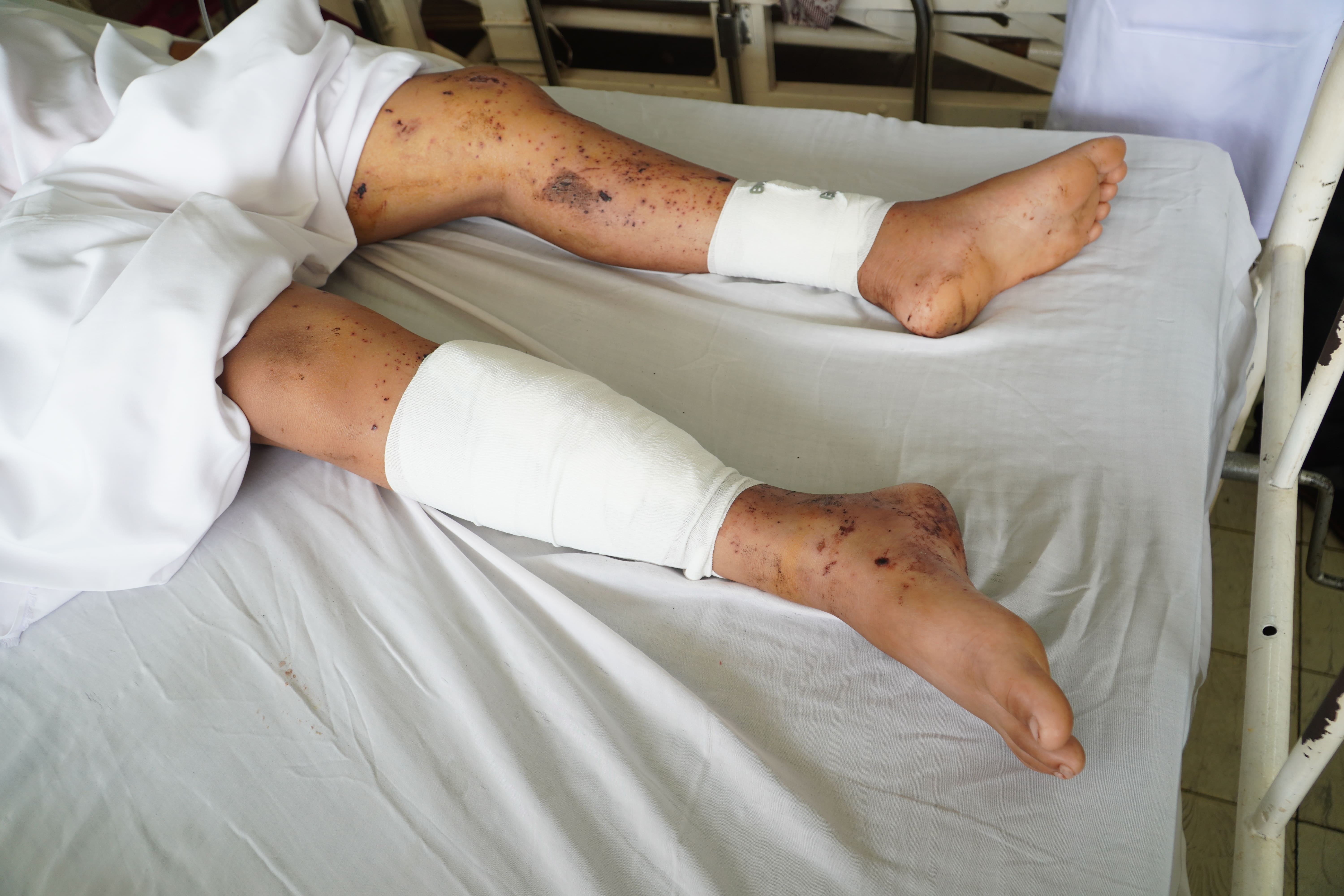 tu vong vi phao anh 1