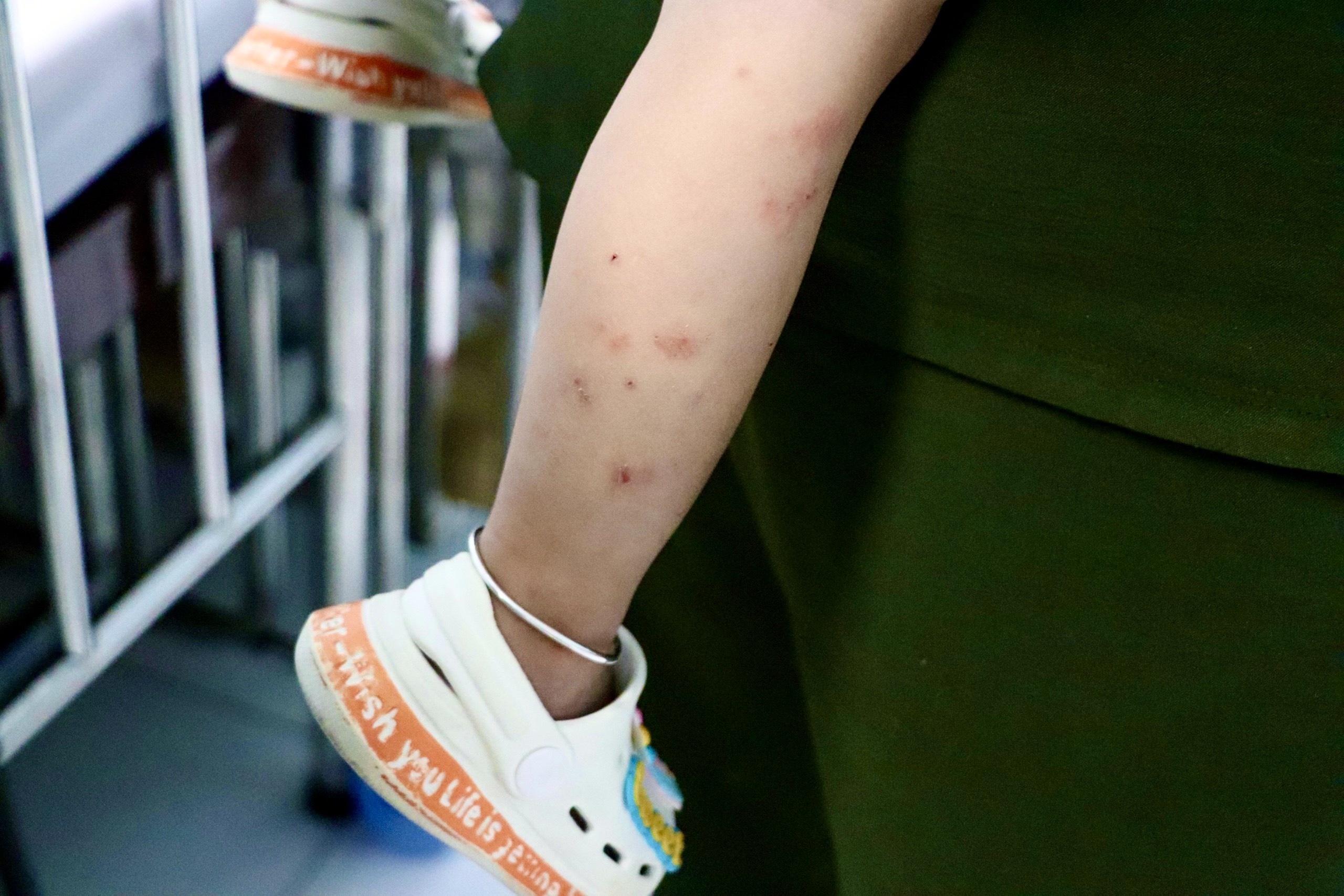 Phat hien con mac tay chan mieng do nang nho bieu hien la hinh anh