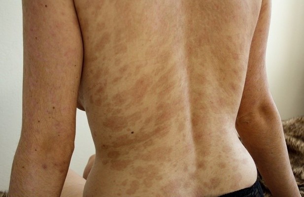 Trot da, loet vung sinh duc do di ung thuoc hinh anh